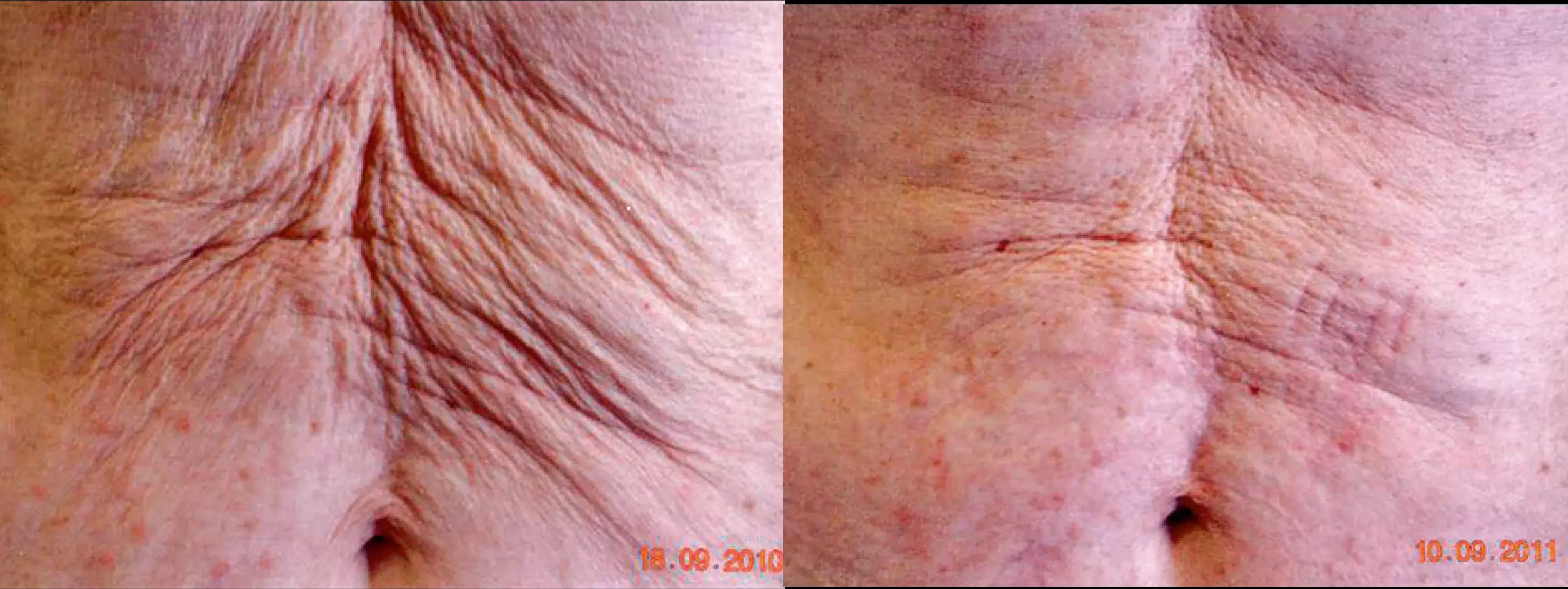 Body Sculpting & Tightening Before & After