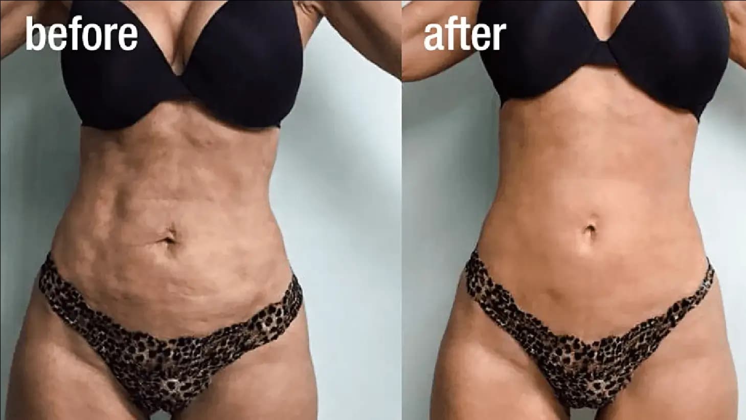 Body Sculpting & Tightening Before & After