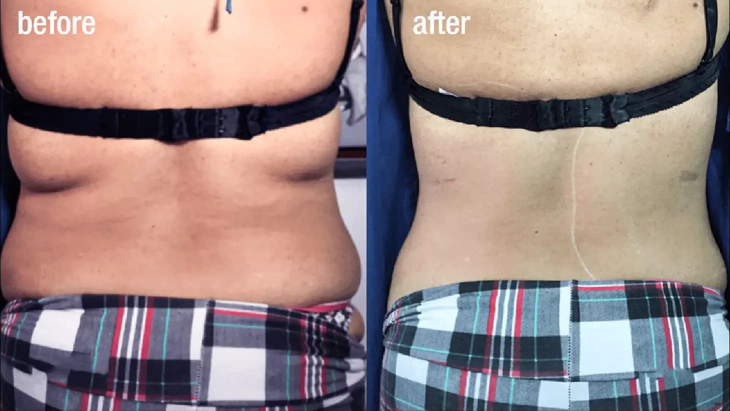 Body Sculpting & Tightening Before & After