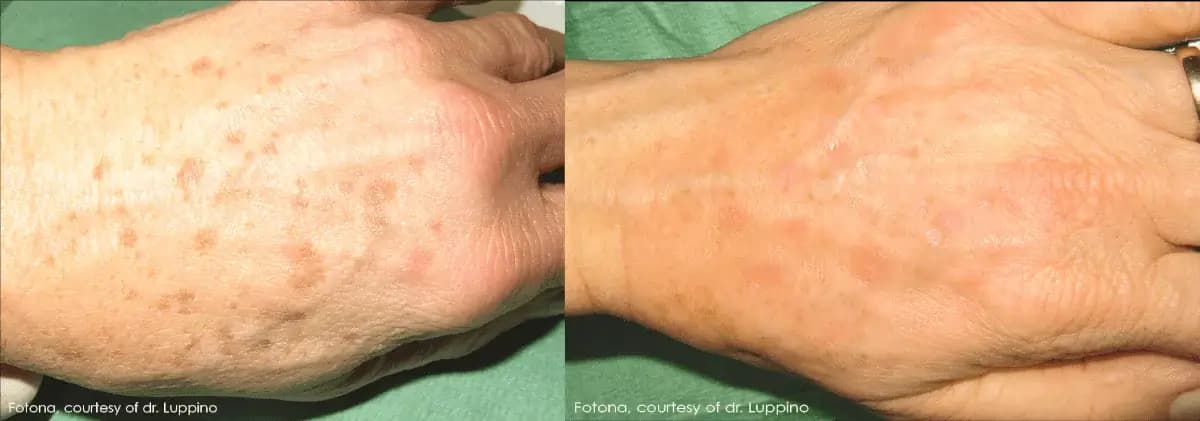Age Spots | Sun Damage
