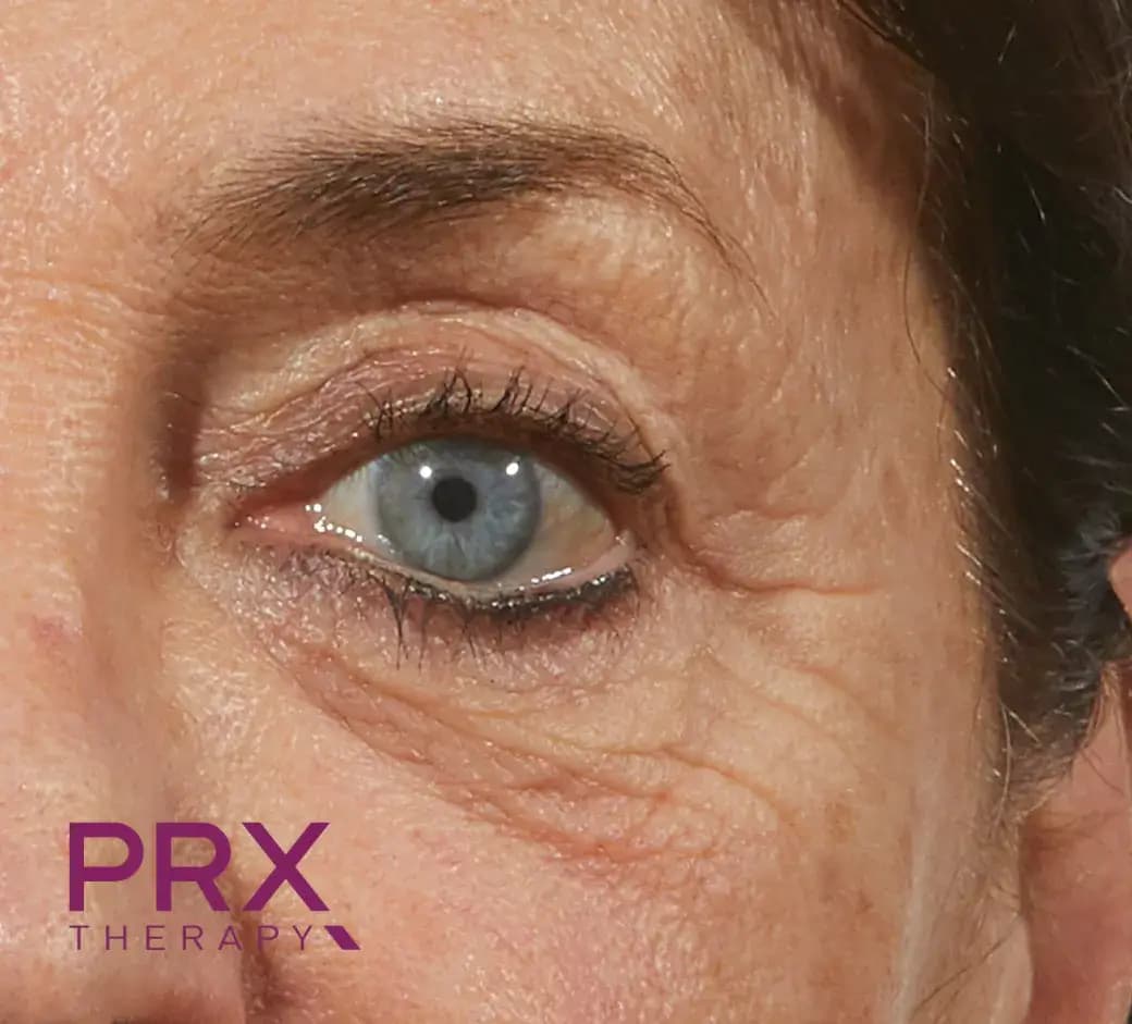 After Eye Area A