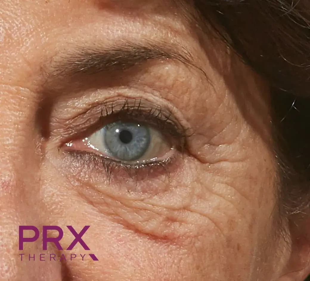 Before Eye Area A