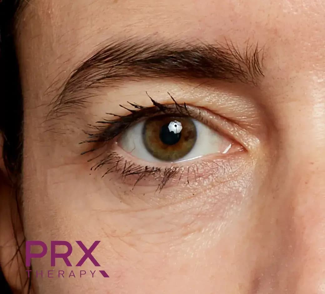 After Eye Area B