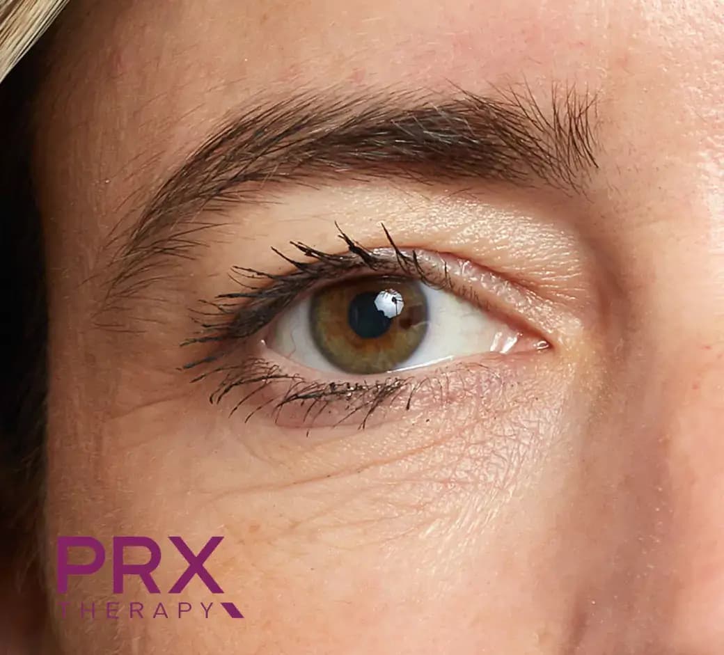Before Eye Area B