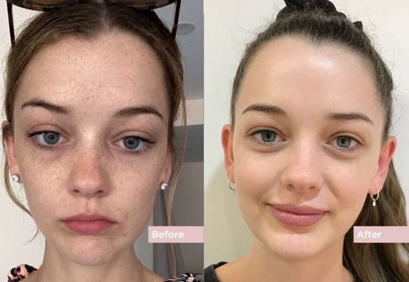 Laser Pigmentation Treatment