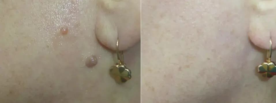 Warts - Before and after comparison