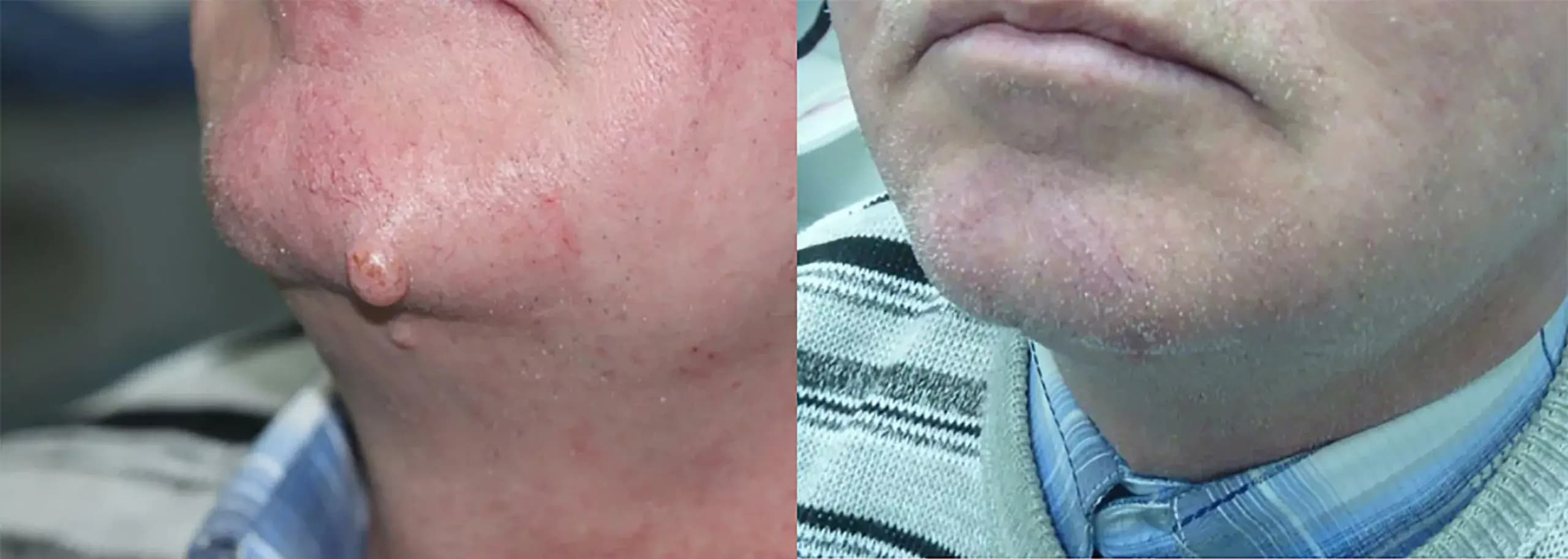 Warts - 2 months after treatment
