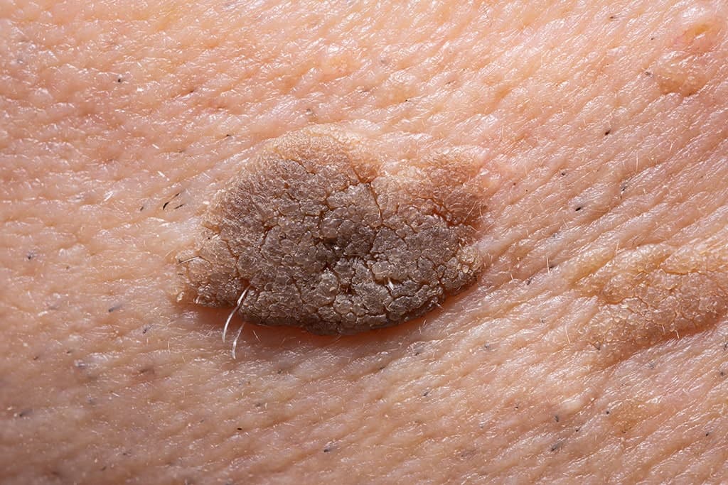 Seborrheic Keratoses