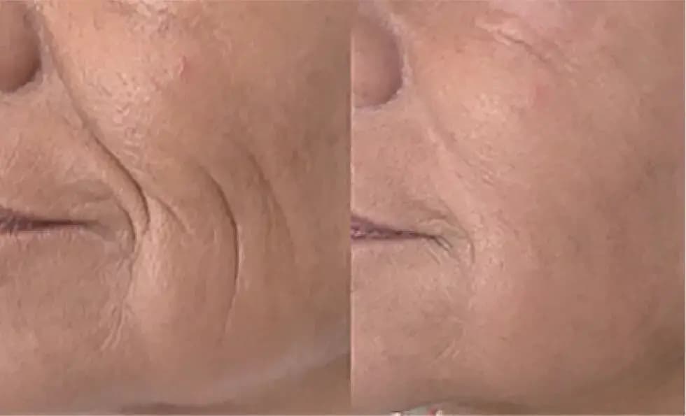 Before & After Treatment - SmoothLiftin