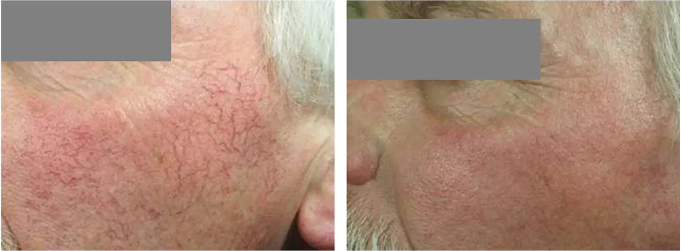 Couperose Before & After