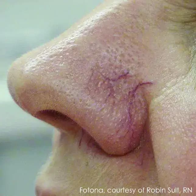 Before Treatment
