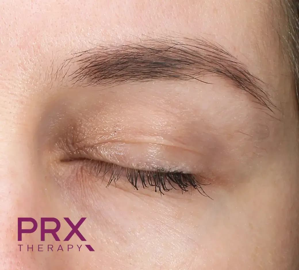 Before Upper Eyelid and Eyebrow