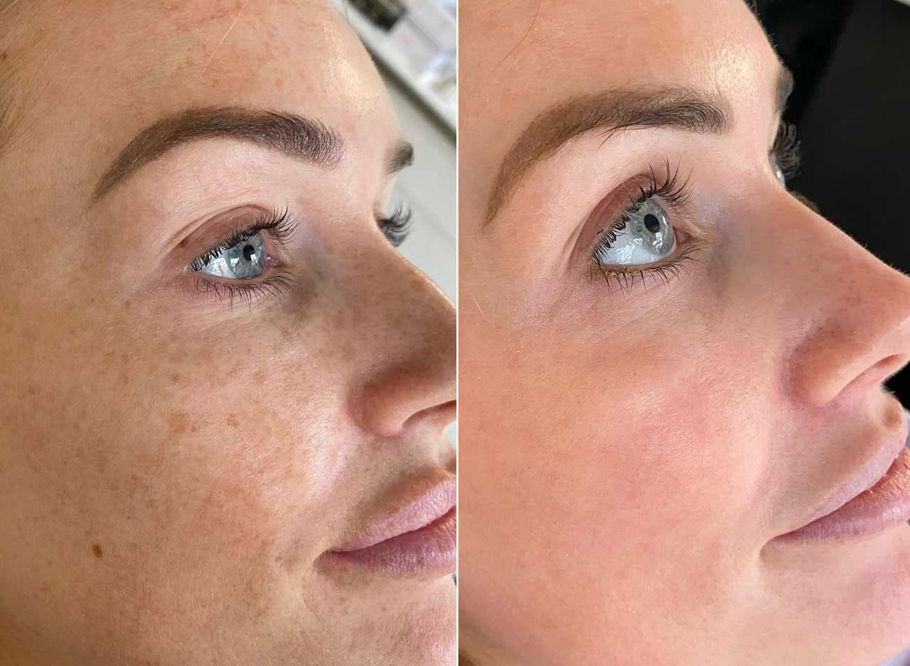 Chemical Peels