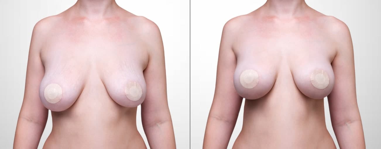 Breast reduction surgery result