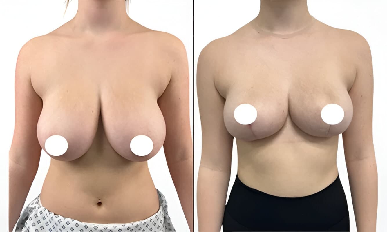 Breast reduction before and after comparison