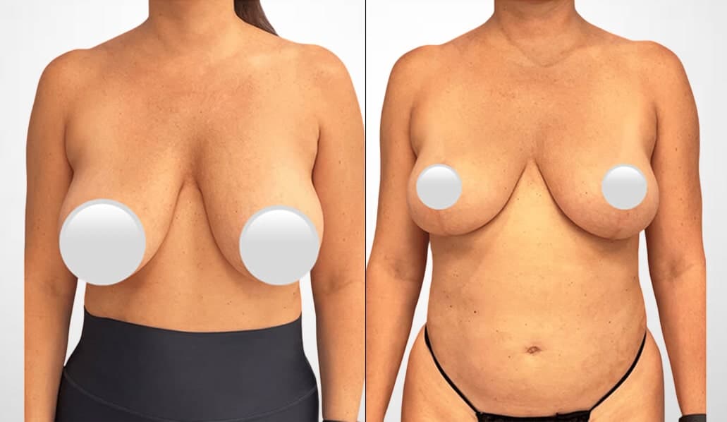 Breast reduction procedure