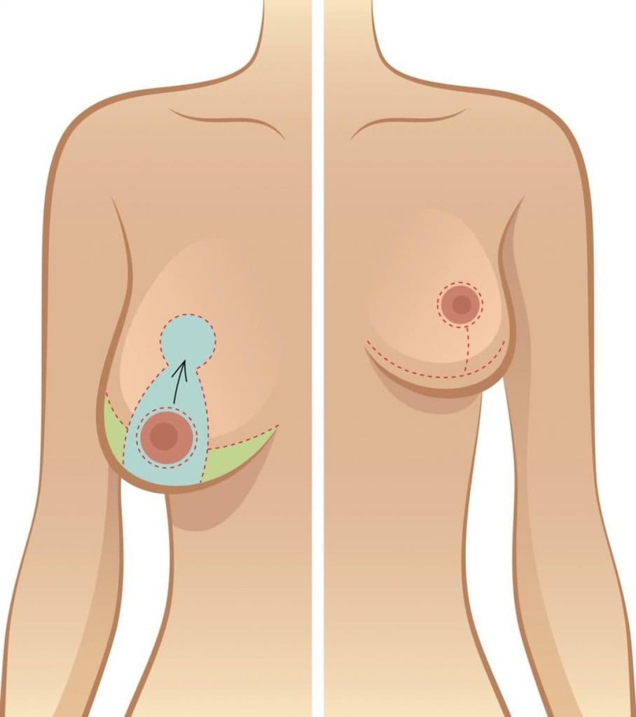 Diagram of breast reduction incision patterns