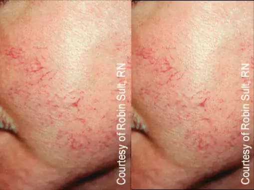 Couperose Before & After