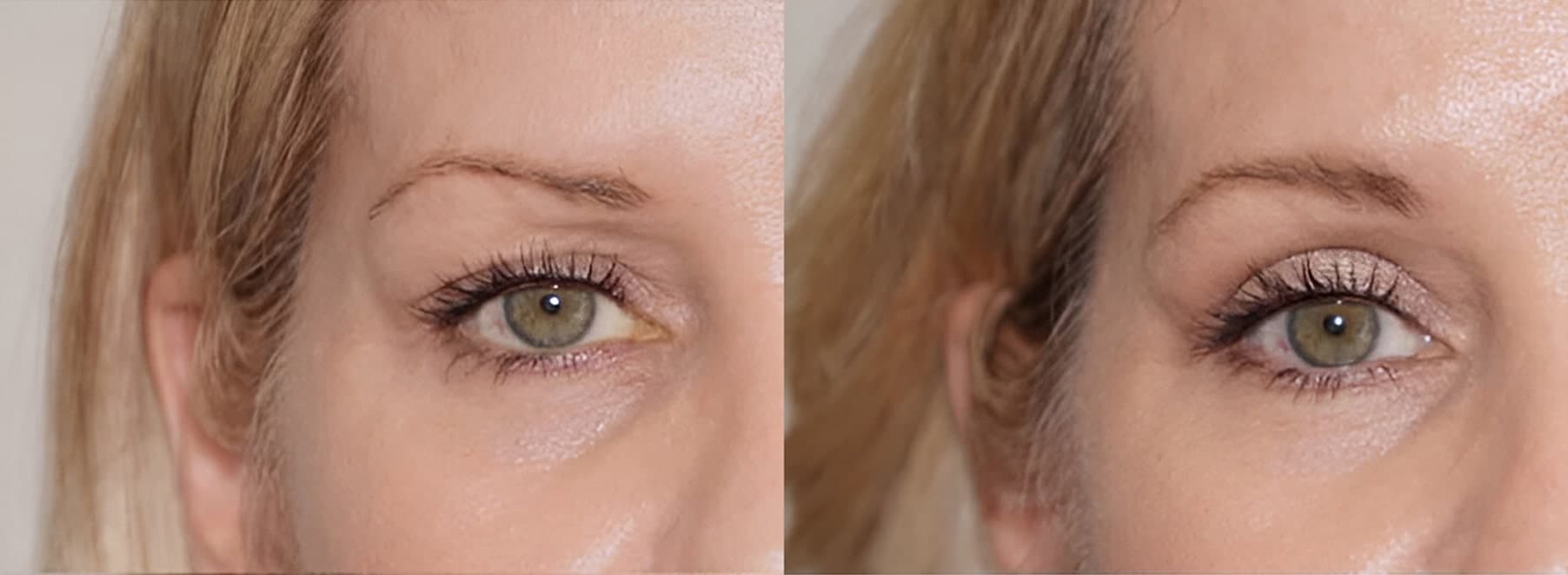Before & After - Patient 1