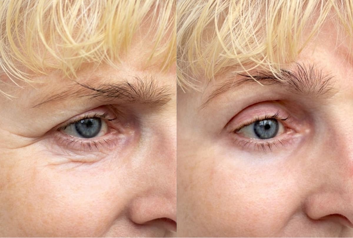 Before & After - Patient 3