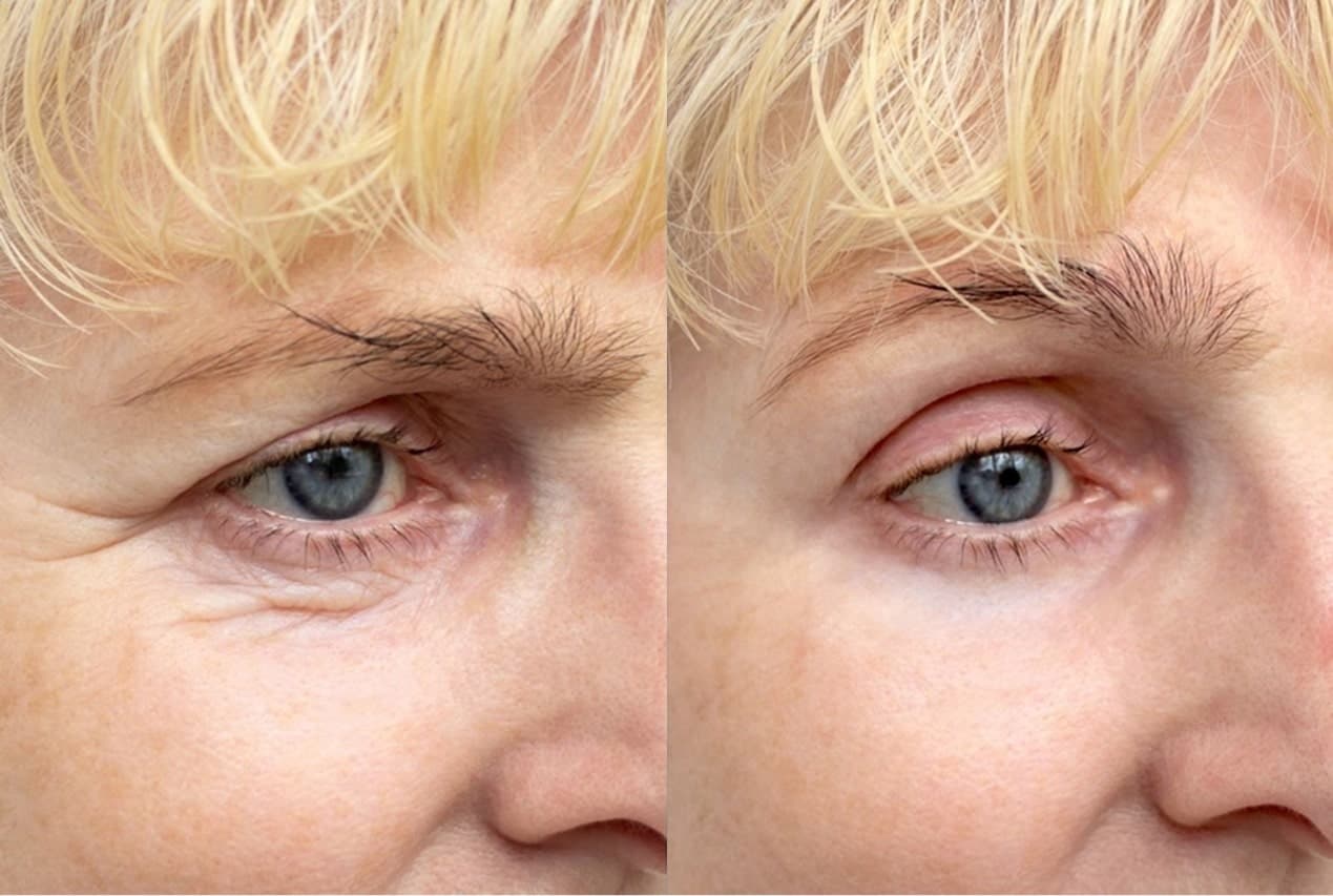 Before & After - Patient 3