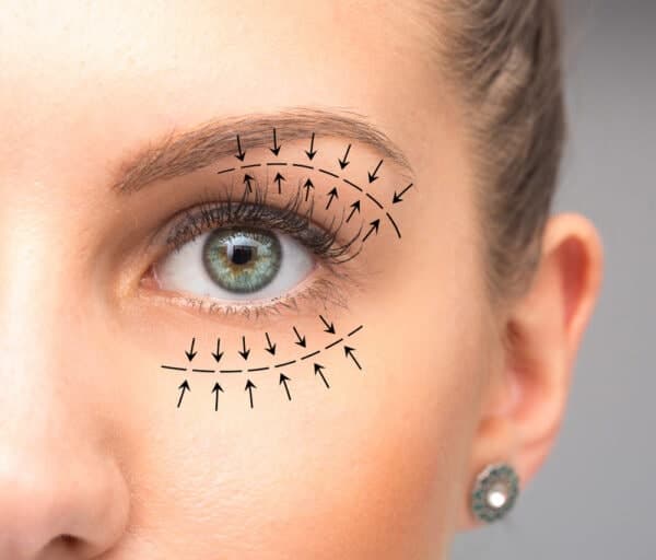 Eyelid lift procedure illustration