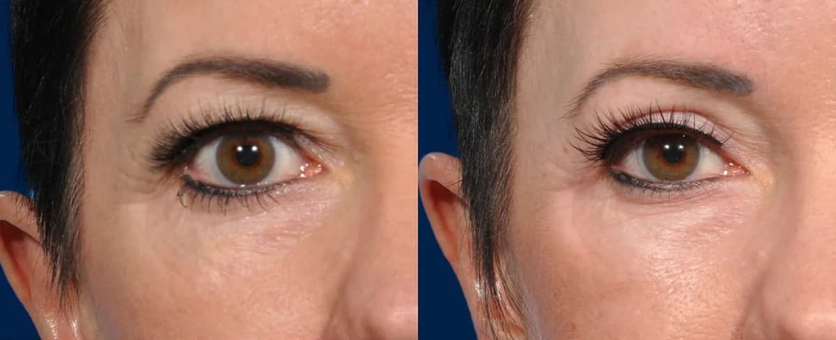 Before & After - Patient 4