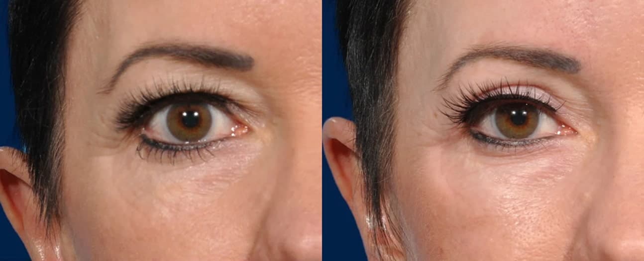Before & After - Patient 4