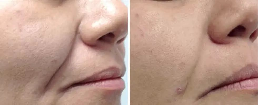 Before & After Treatment - Complete Results
