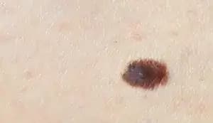 Skin Tumors