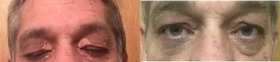 Xanthelasma