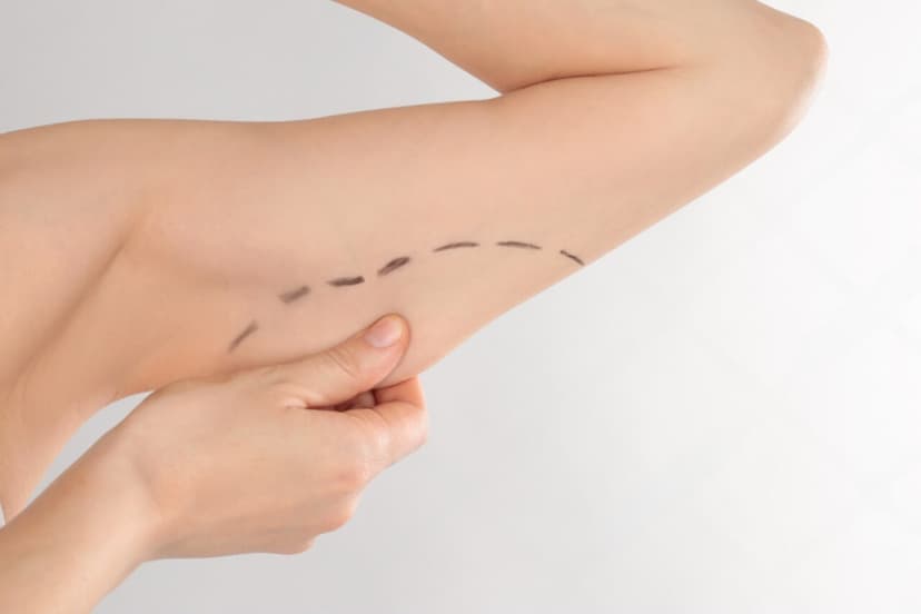 Brachioplasty (Upper Arm Lift)