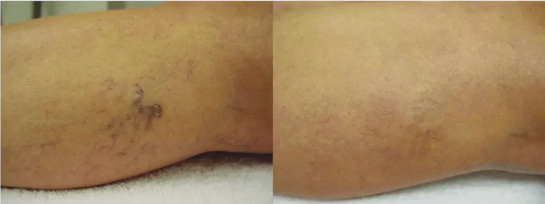 Spider Veins